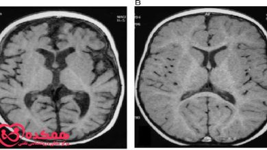 آتروفی مغزی چیست؟