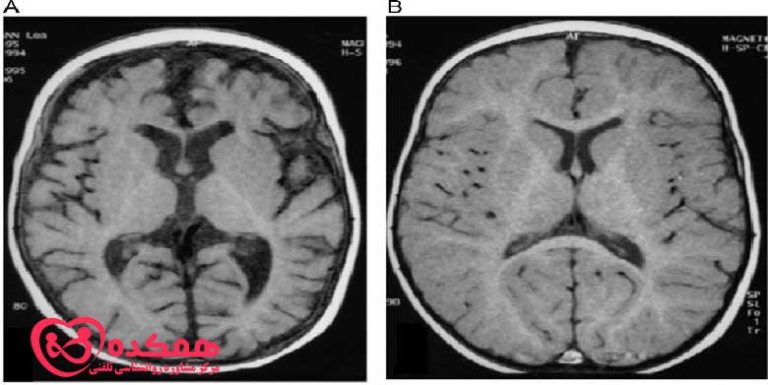 آتروفی مغزی | همکده