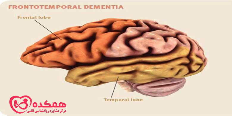 علائم رایج و علل ابتلا به زوال عقل که همه باید درباره آنها بدانند