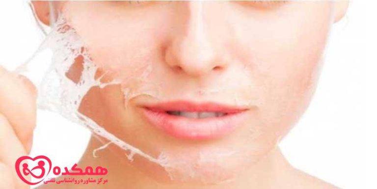 اختلال چیدن پوست | همکده