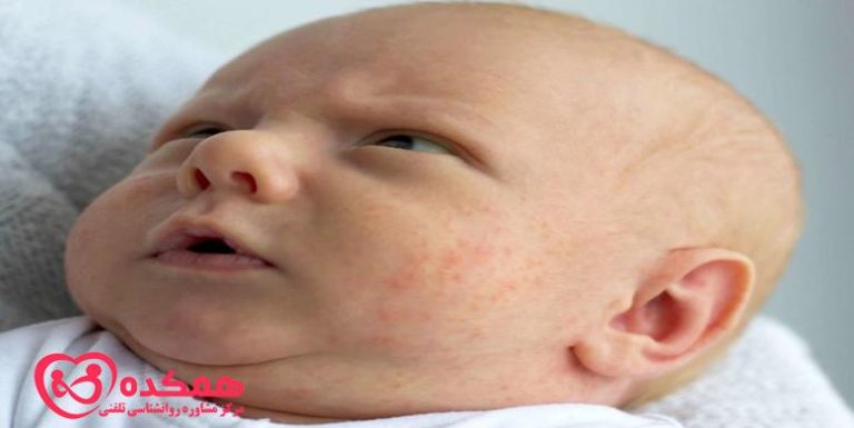 آکنه نوزاد | همکده