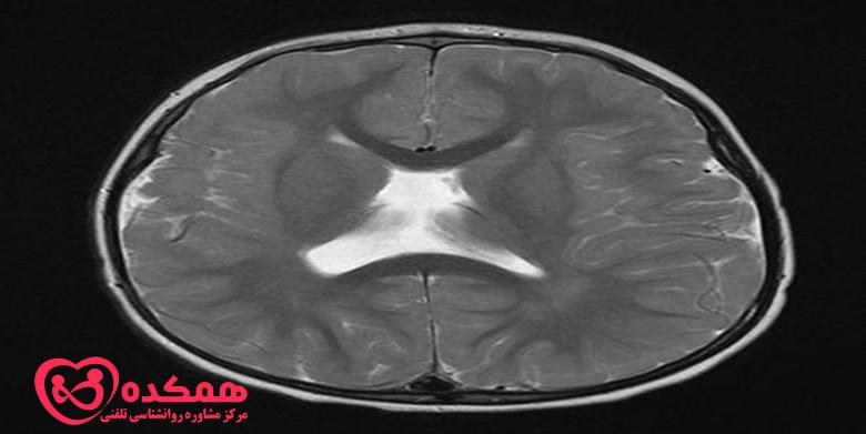 دیسپلازی قشر مغز در کودکان چیست؟