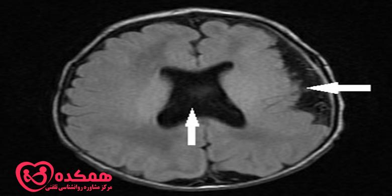 دیسپلازی قشر مغز در کودکان چیست؟